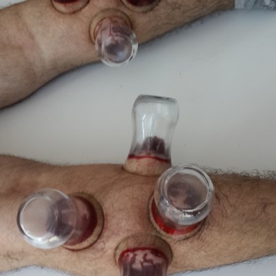  Eklem ağrıları hacamat