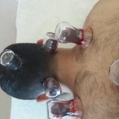  Hacamat Uygulamaları