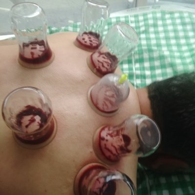  Omuz agrilari hacamat